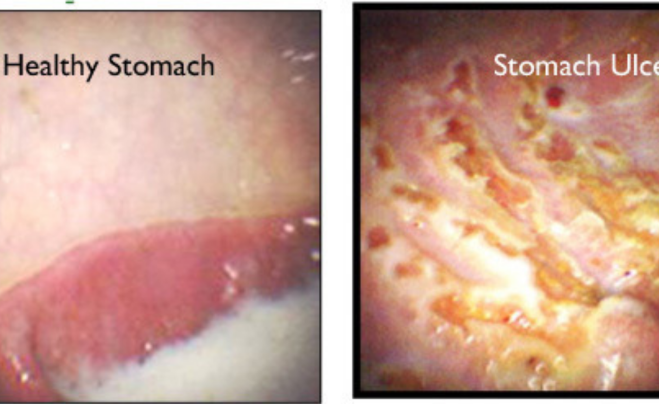 Gastroscopy images of healthy and ulcered stomachs